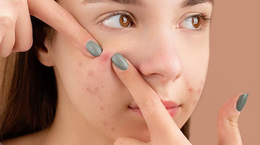 Sivilceleri en hızlı şekilde geçirmek için 