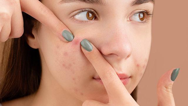 Sivilceleri en hızlı şekilde geçirmek için 