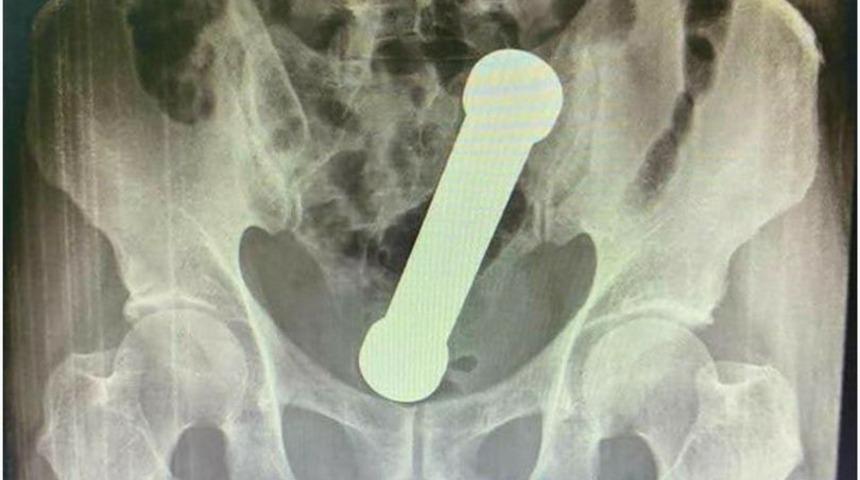 Kaba etinden iki kiloluk dambıl çıktı!