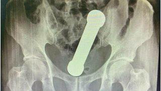 Kaba etinden iki kiloluk dambıl çıktı!