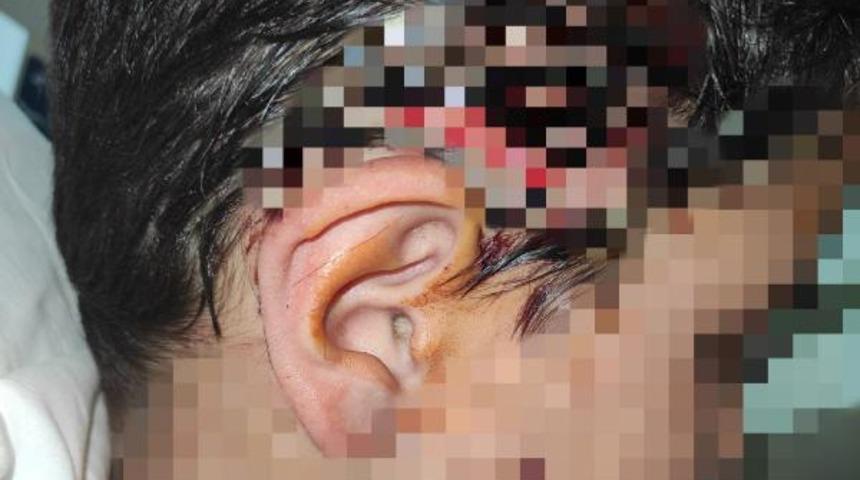 Bursa'da sokak k&ouml;peği dehşeti! Okul yolunda 8 k&ouml;peğin saldırdığı &ccedil;ocuğun v&uuml;cuduna 80 dikiş atıldı