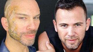 Berksan aylar sonra ortaya çıktı! Fransız askısı yaptırmıştı