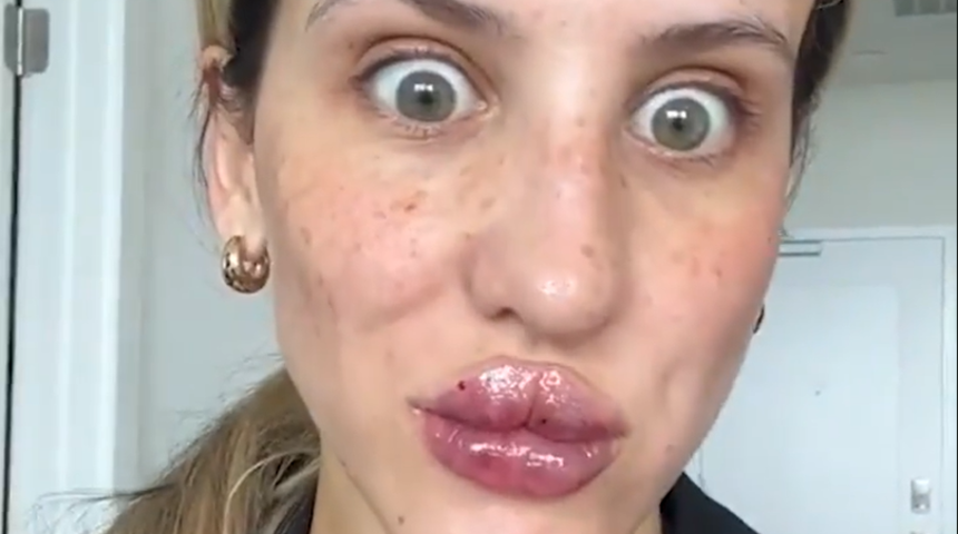 Estetik operasyonu sosyal medyadan paylaştı! Gördüklerine inanamadı: Böyle morarmamalısın