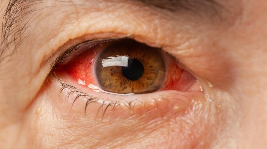Gözlerinizi sakın kaşımayın! Görme kaybı yaşayabilirsiniz