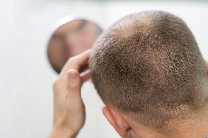 Türkiye’de her 10 erkekten 7’sinde var: Saç ekiminde doğru bilinen yanlışlar!