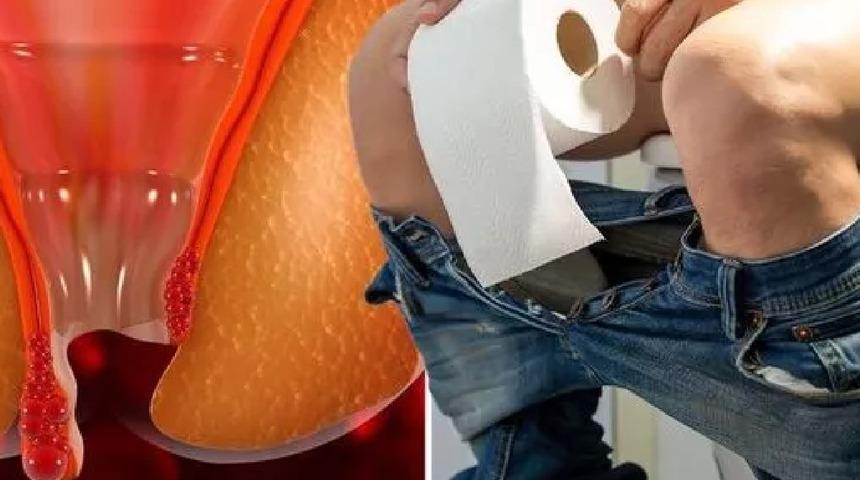 Tuvalette uzun kalıyorsanız dikkat! Hemoroid bu yüzden oluyor