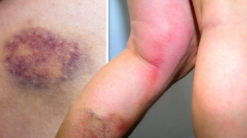 Aynı şey değiller: Tedavi edilmezse tahribatı büyük! Kan pıhtısı nasıl anlaşılır? Morlukla kan pıhtısı arasındaki fark nedir?