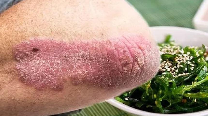 Zona hastalığı tedavisi için bol bol tüketin