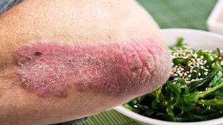 Zona hastalığı tedavisi için bol bol tüketin