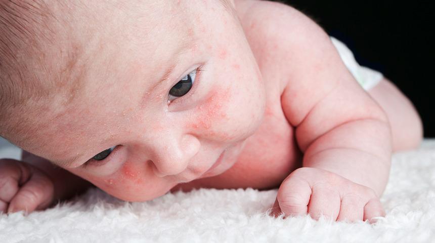 Sıcak havalara dikkat! Bebeklerde sıklıkla görülüyor 