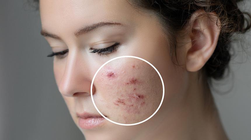 Sivilcesiz bir cilt için bunları bilmeniz gerekiyor