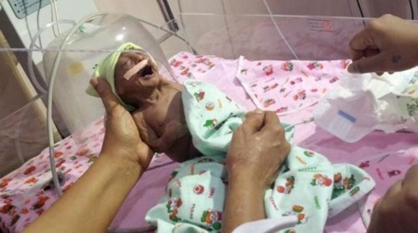 Buruşuk doğdu, anne ve babası terk etti