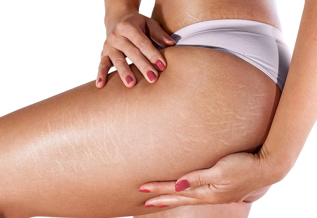 V&uuml;cut &ccedil;atlakları i&ccedil;in evde yapacağınız etkili ve basit y&ouml;ntemler 