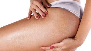 Vücut çatlakları için evde yapacağınız etkili ve basit yöntemler 