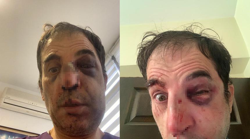 Burun ameliyatını beğenmeyen kadın, profesöre dehşeti yaşattı! 3 yıl sonra...