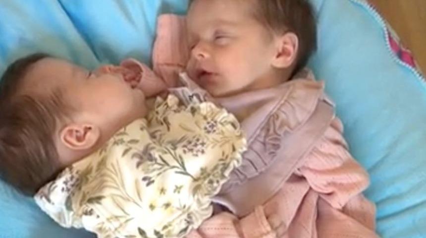 Birbirlerine yapışık olarak doğan ikiz kardeşler mucize olarak isimlendirildi! “Sürekli sarılıyormuş gibi”