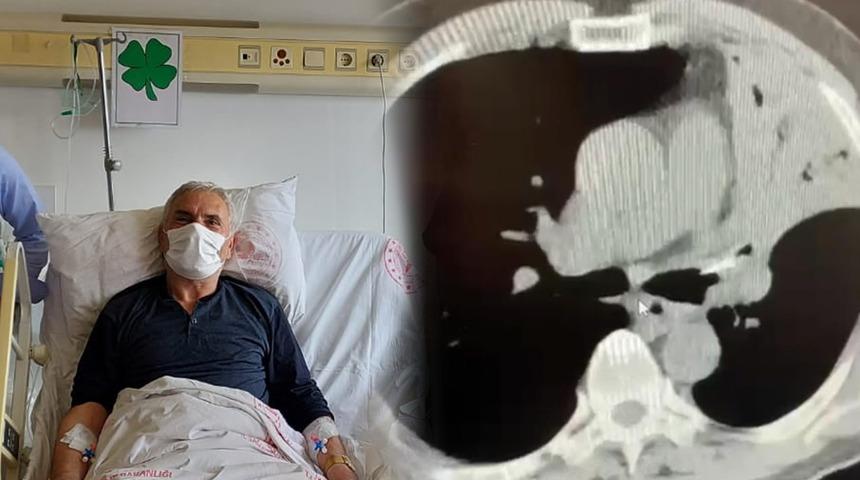 Akciğerinde tespit edildi! Şaşkına çeviren olay, 5 yıl boyunca...