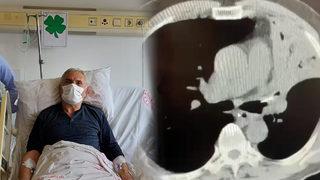 Akciğerinde tespit edildi! Şaşkına çeviren olay, 5 yıl boyunca...