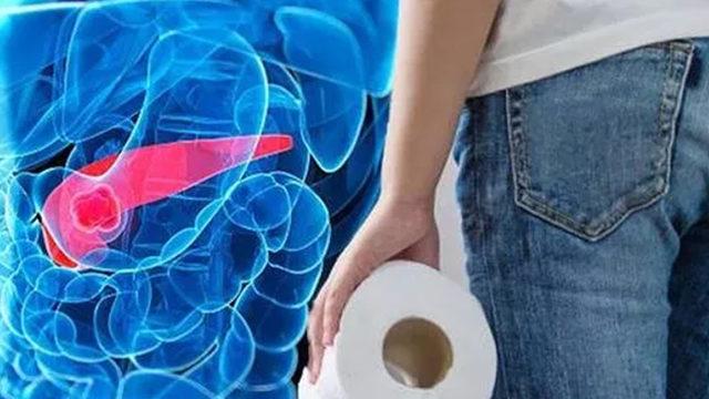 Bu belirtilerden biri bile varsa hastaneye koşun! Pankreas kanseri belirtileri nelerdir?