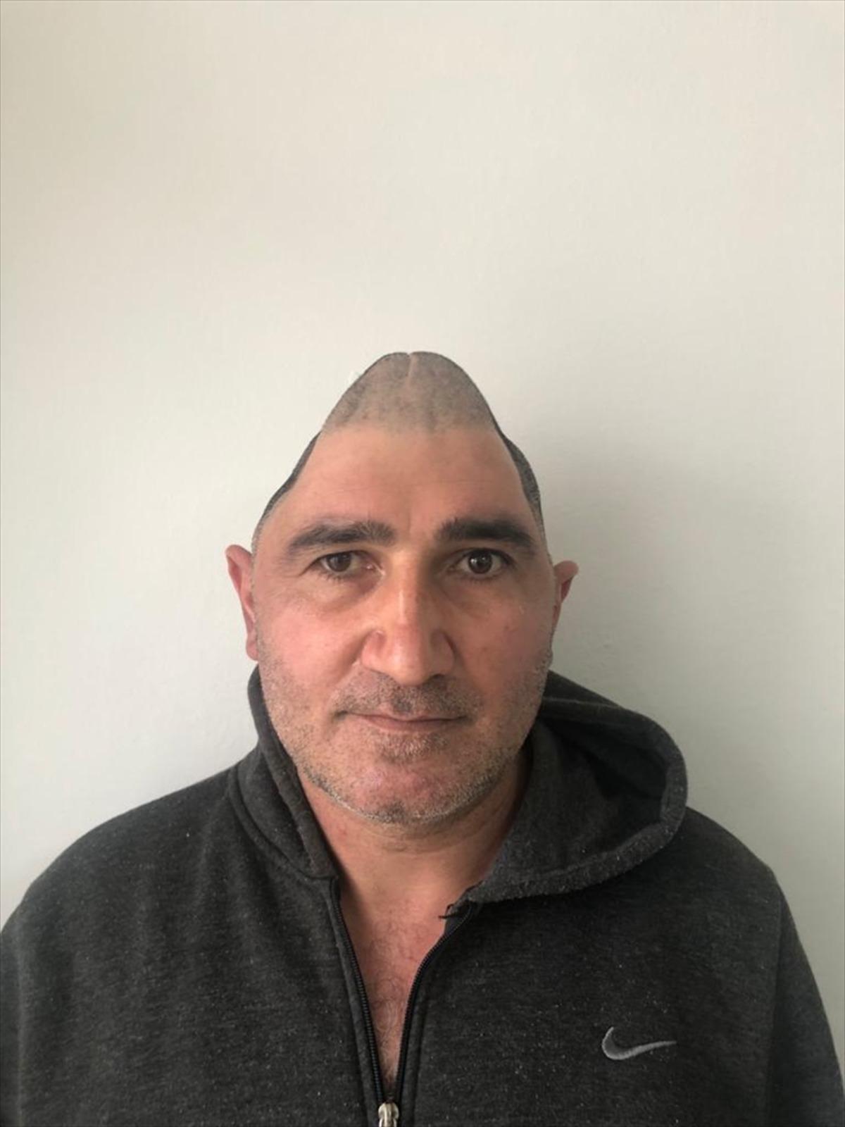 Kafatasının y&uuml;zde 83'&uuml; par&ccedil;alanan hasta, titanyum par&ccedil;alarıyla eski g&ouml;r&uuml;nt&uuml;s&uuml;ne kavuştu