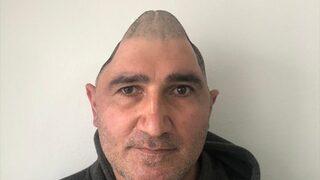 Kafatasının yüzde 83'ü parçalanan hasta, titanyum parçalarıyla eski görüntüsüne kavuştu