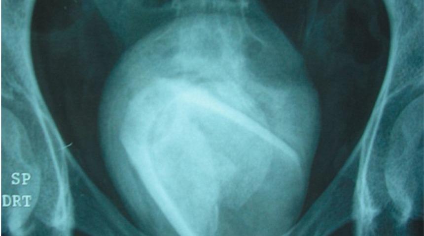 Mesanesine cinsel ilişki oyuncağı sıkıştığını fark etmedi! Hastalığının nedenini öğrenince şoke oldu