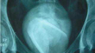 Mesanesine cinsel ilişki oyuncağı sıkıştığını fark etmedi! Hastalığının nedenini öğrenince şoke oldu