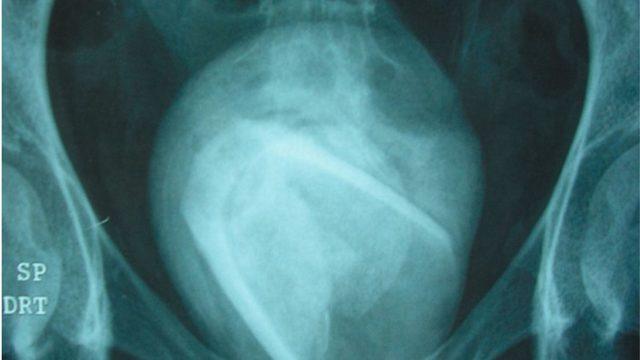 Mesanesine cinsel ilişki oyuncağı sıkıştığını fark etmedi! Hastalığının nedenini öğrenince şoke oldu