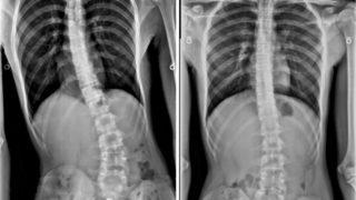 Normal bel ağrısı sandı, ayna karşısına geçince şaşkına döndü! 'Vücudumun eğri olduğunu fark ettim'