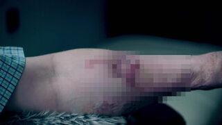 6 yıl boyunca kolunda bir penisle yaşadı! Doğru yere koydular, gerçek bir erkek gibi hissediyorum”