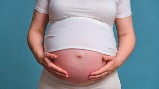 Hamilelik döneminde artmaya başlıyor! Cilt lekelerinde dikkat edilmesi gerekenler