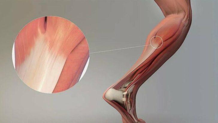 AŞİL TENDONU NEREDE? Aşil tendonu nasıl yırtılır? Aşil tendonu kopması nedir? Aşil tendonu vücutta nerededir?