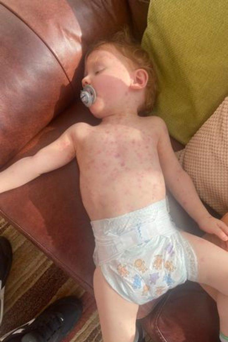 Küçük bir lekeyle başladı! Annesi basit bir döküntü zannetti, dakikalar içinde tüm vücudunu sardı G1