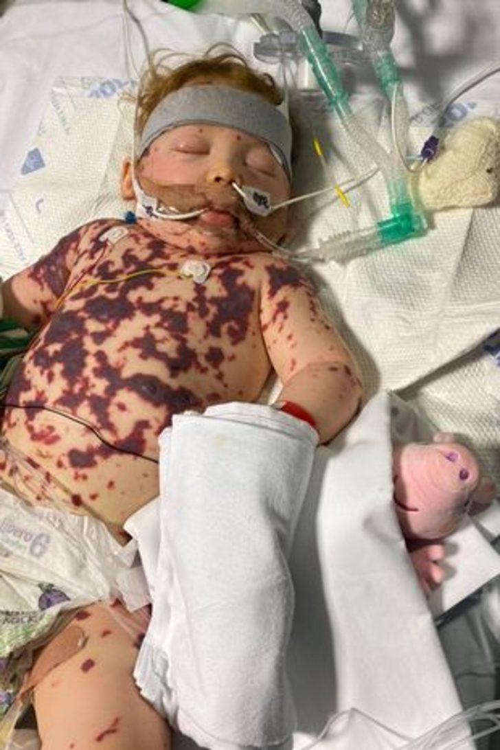 Küçük bir lekeyle başladı! Annesi basit bir döküntü zannetti, dakikalar içinde tüm vücudunu sardı G2