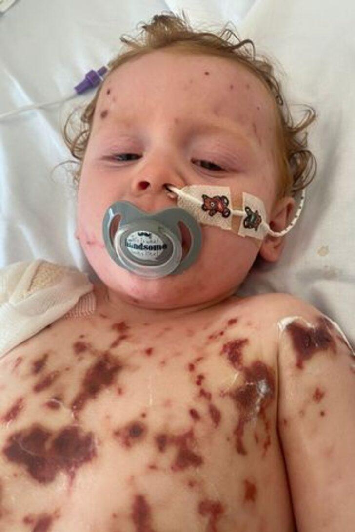 Küçük bir lekeyle başladı! Annesi basit bir döküntü zannetti, dakikalar içinde tüm vücudunu sardı G3