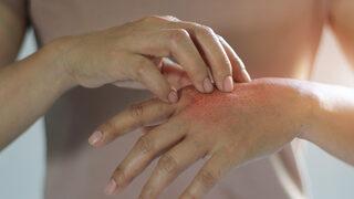 Dikkat! Bunları yemek egzamayı tetikleyebilir  