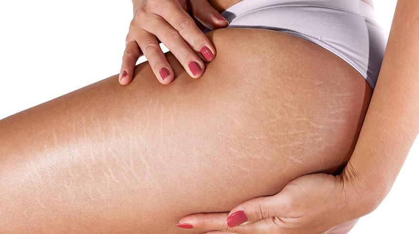 Çatlaklarınızdan kolayca kurtulabilirsiniz 