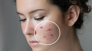 Yazın bu ürünü kullanmak sivilceye neden oluyor! Doğru cilt bakımı nasıl olmalı?
