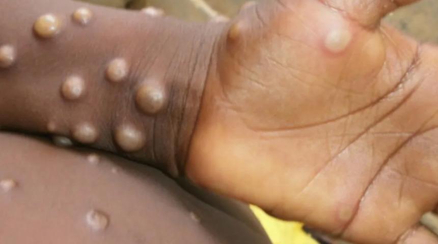 İngiliz hükümeti resmen doğruladı! Şimdi de maymun çiçeği virüsü hastalığı (Monkeypox) endişesi