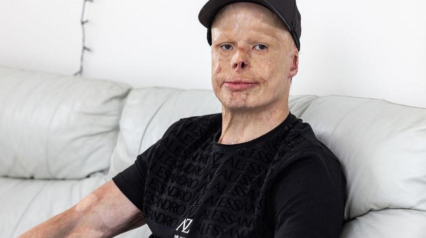 11.000 voltluk şokun ardından 'ateş topu'na d&ouml;nd&uuml;! ''Birka&ccedil; dakikalığına &ouml;l&uuml;yd&uuml;m''