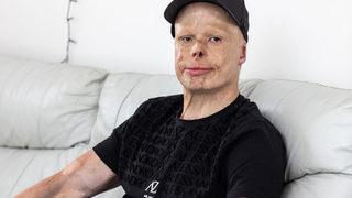 11.000 voltluk şokun ardından 'ateş topu'na döndü! ''Birkaç dakikalığına ölüydüm''