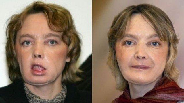 Dünyanın ilk yüz nakli yapılan hastası öldü