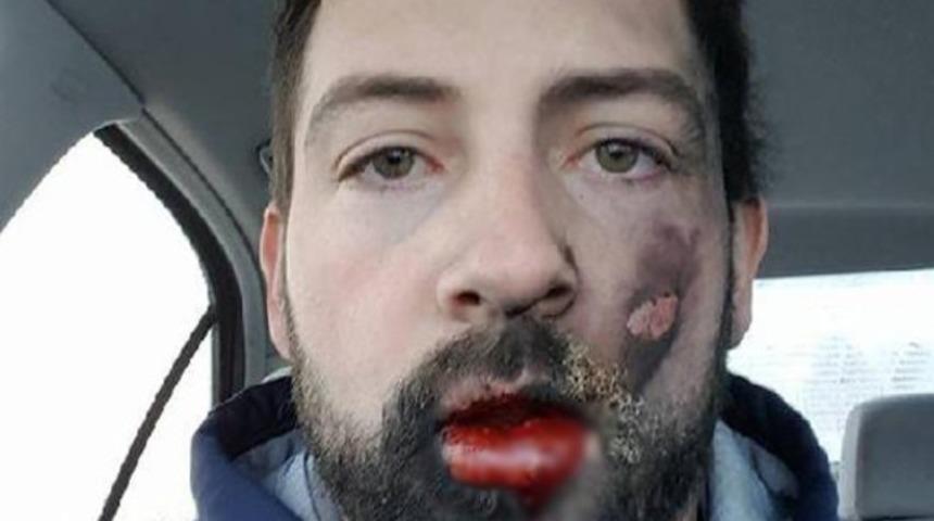 Elektronik sigara suratında patladı, yedi dişini kaybetti