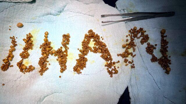 Safra kesesinden çıkanlar, doktoru bile şaşırttı! İlk kez karşılaştım