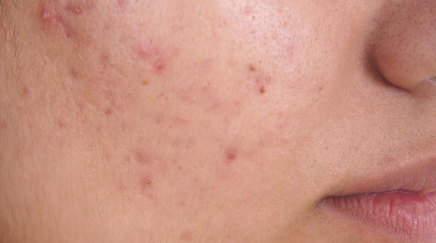 Sadece bir haftada sivilce lekelerine elveda!