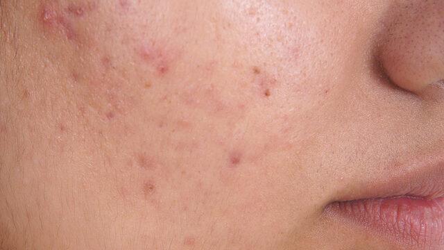 Sadece bir haftada sivilce lekelerine elveda!