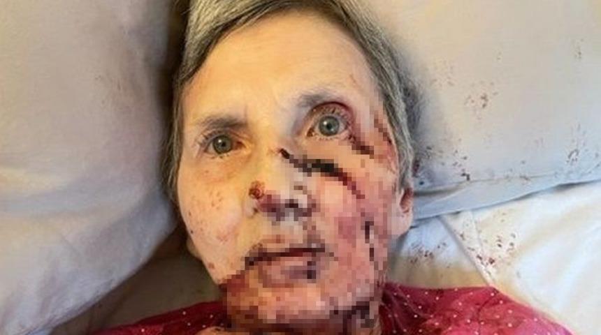 Uyurken dev bir farenin saldırısına uğrayan kadın, hastanelik oldu! “Kemiğe kadar kemirmeye çalışmış”