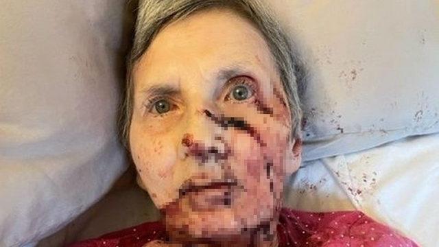 Uyurken dev bir farenin saldırısına uğrayan kadın, hastanelik oldu! “Kemiğe kadar kemirmeye çalışmış”