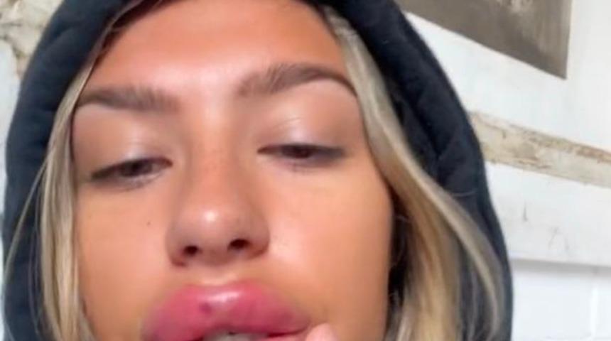 Rus dudak estetiğinden pişman oldu! “Dudaklarım o kadar büyük ki...”