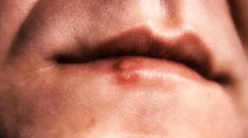 En sık T&uuml;rkiye&rsquo;de g&ouml;r&uuml;l&uuml;yor